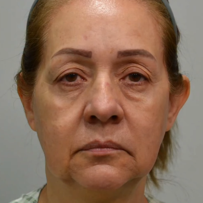 Before treatment