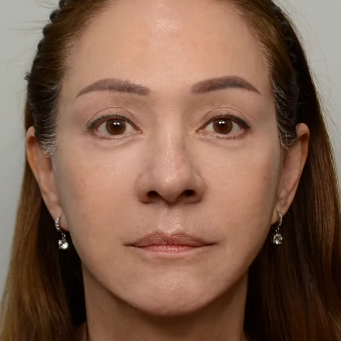 After treatment