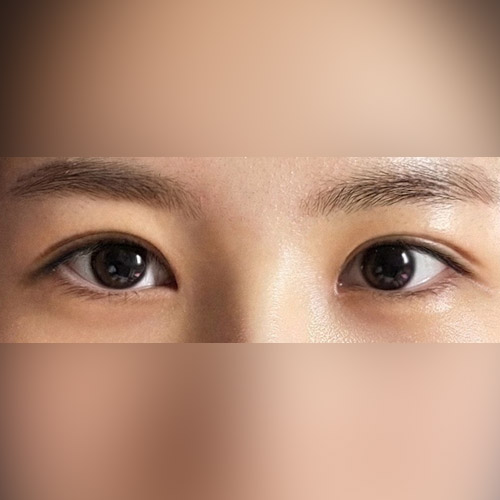 Eye Surgery
