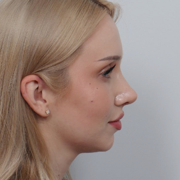 After transformation